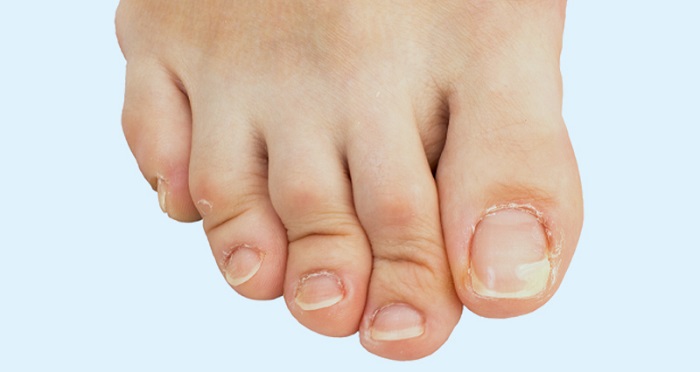 کلینیک فوق تخصصی پا |انگشت چنگالی پا
