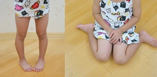 کلینیک فوق تخصصی پا |کج راه رفتن کودک