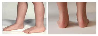 دکتر کف پای صاف |صافی کف پا در کودکان