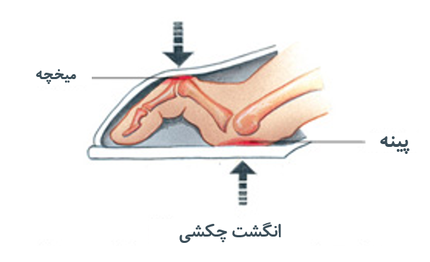 کلینیک فوق تخصصی پا | انواع انگشت چکشی