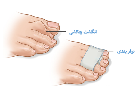 کلینیک فوق تخصصی پا |انگشت چکشی
