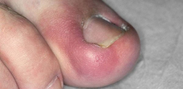 آیا وقتی کفش می پوشید در ناخن پای خود احساس درد می کنید؟